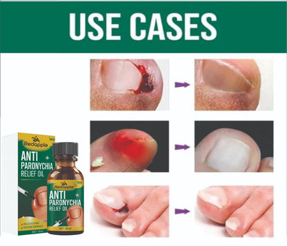 Anti Paronychia Relief Oil: Buy 1 Get 1 Free