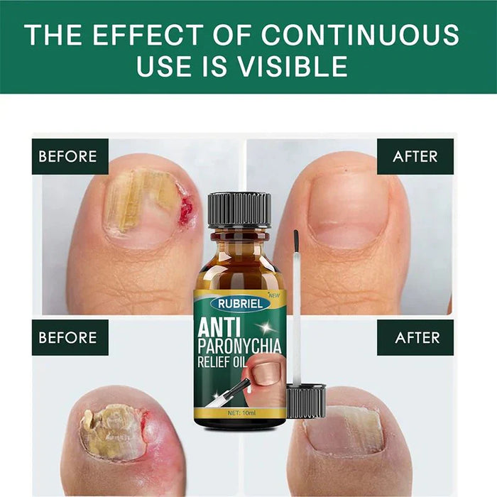 Anti Paronychia Relief Oil: Buy 1 Get 1 Free